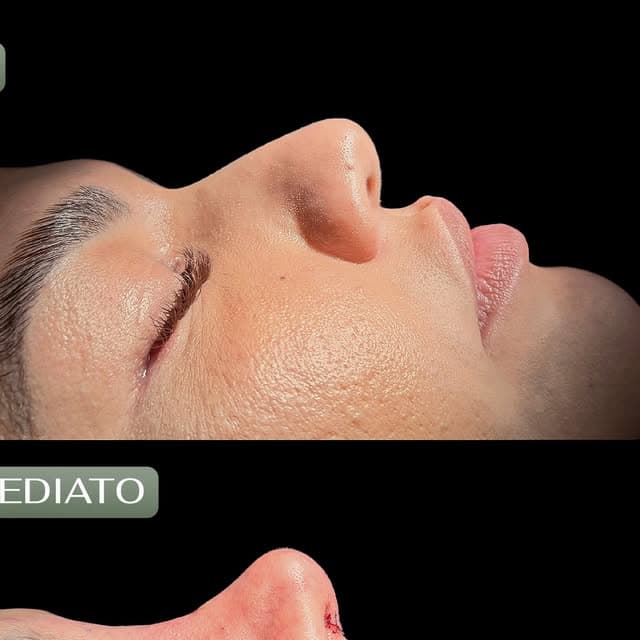 Rejuvenescimento dos olhos